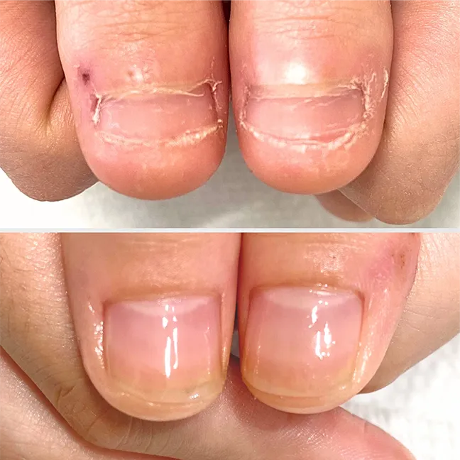深爪 地爪育成ケア ビフォーアフター｜自爪育成 スクール