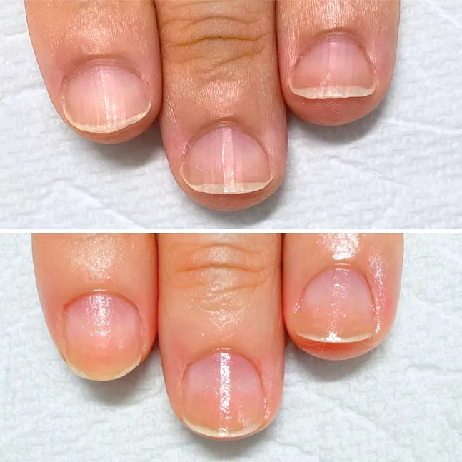 ちび爪 地爪育成 改善事例｜岐阜 ネイルスクール