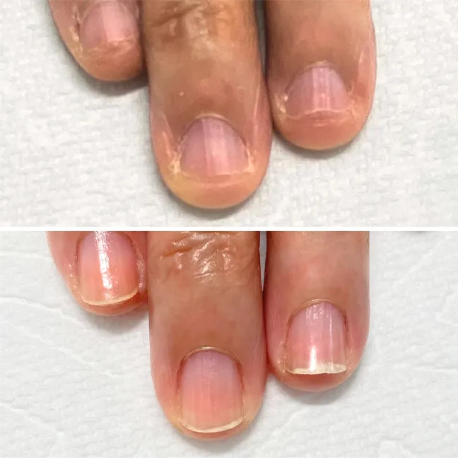 噛み爪 地爪育成 改善事例｜自爪育成 講座