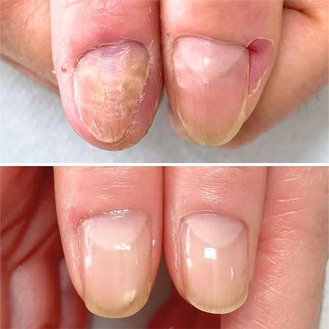 凸凹爪 地爪育成 改善事例｜岐阜 ネイルスクール