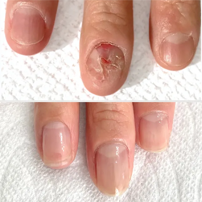 割れ爪 地爪育成 改善ケア｜地爪ソムリエネイリスト講座